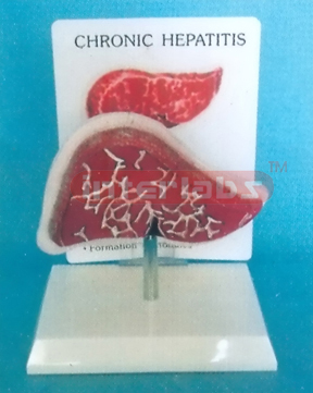 DESK TYPE CHRONIC HEPATATIS MODEL WITH DESCRIPTION PLATE